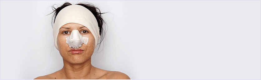 Cuidados después de una Rinoplastia cuidados-después-de-una-rinoplastia-