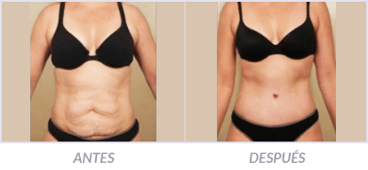 Abdominoplastia-01-Cirujano-Plastico-Mexico-DF-Dr-Victor-Pera-Galvez
