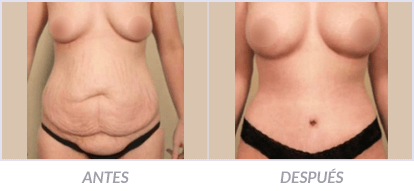 Abdominoplastia-02-Cirujano-Plastico-Mexico-DF-Dr-Victor-Pera-Galvez