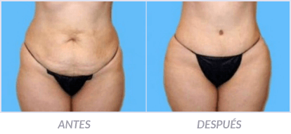 Abdominoplastia-03-Cirujano-Plastico-Mexico-DF-Dr-Victor-Pera-Galvez