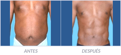 Abdominoplastia-04-Cirujano-Plastico-Mexico-DF-Dr-Victor-Pera-Galvez