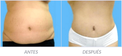 Abdominoplastia-05-Cirujano-Plastico-Mexico-DF-Dr-Victor-Pera-Galvez