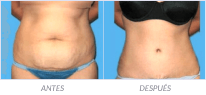 Abdominoplastia-06-Cirujano-Plastico-Mexico-DF-Dr-Victor-Pera-Galvez