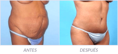 Abdominoplastia-07-Cirujano-Plastico-Mexico-DF-Dr-Victor-Pera-Galvez
