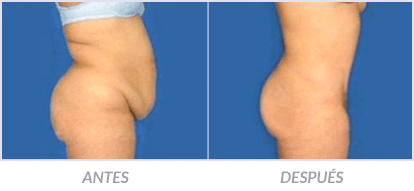 Abdominoplastia-08-Cirujano-Plastico-Mexico-DF-Dr-Victor-Pera-Galvez