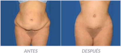 Abdominoplastia-09-Cirujano-Plastico-Mexico-DF-Dr-Victor-Pera-Galvez