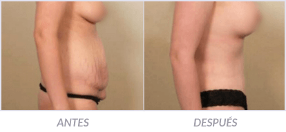 Abdominoplastia-10-Cirujano-Plastico-Mexico-DF-Dr-Victor-Pera-Galvez