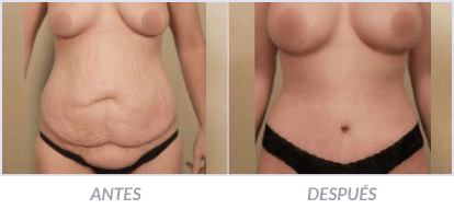 Abdominoplastia-11-Cirujano-Plastico-Mexico-DF-Dr-Victor-Pera-Galvez