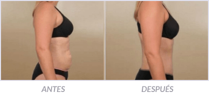 Abdominoplastia-12-Cirujano-Plastico-Mexico-DF-Dr-Victor-Pera-Galvez