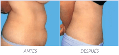 Abdominoplastia-13-Cirujano-Plastico-Mexico-DF-Dr-Victor-Pera-Galvez