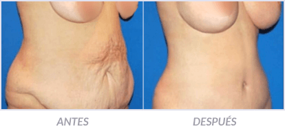 Abdominoplastia-14-Cirujano-Plastico-Mexico-DF-Dr-Victor-Pera-Galvez