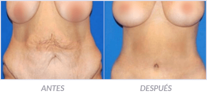 Abdominoplastia-15-Cirujano-Plastico-Mexico-DF-Dr-Victor-Pera-Galvez