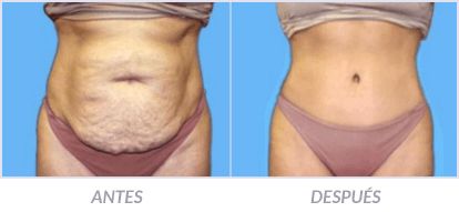 Abdominoplastia-17-Cirujano-Plastico-Mexico-DF-Dr-Victor-Pera-Galvez