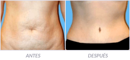 Abdominoplastia-18-Cirujano-Plastico-Mexico-DF-Dr-Victor-Pera-Galvez