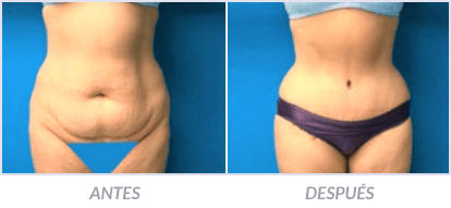 Abdominoplastia-19-Cirujano-Plastico-Mexico-DF-Dr-Victor-Pera-Galvez