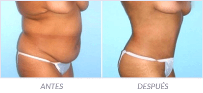 Abdominoplastia-20-Cirujano-Plastico-Mexico-DF-Dr-Victor-Pera-Galvez