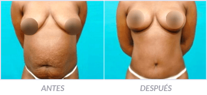 Abdominoplastia-21-Cirujano-Plastico-Mexico-DF-Dr-Victor-Pera-Galvez