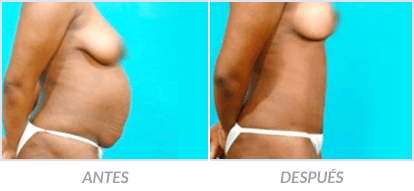 Abdominoplastia-22-Cirujano-Plastico-Mexico-DF-Dr-Victor-Pera-Galvez
