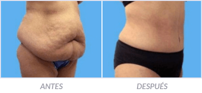 Abdominoplastia-24-Cirujano-Plastico-Mexico-DF-Dr-Victor-Pera-Galvez
