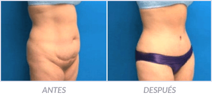 Abdominoplastia-25-Cirujano-Plastico-Mexico-DF-Dr-Victor-Pera-Galvez