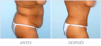 Abdominoplastia-26-Cirujano-Plastico-Mexico-DF-Dr-Victor-Pera-Galvez