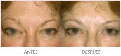 Blefaroplastia-03-Cirujano-Plastico-Mexico-DF-Dr-Victor-Pera-Galvez