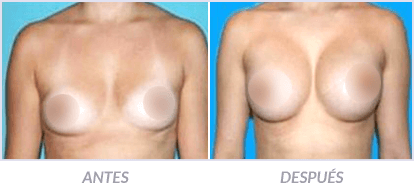 Implantes-de-Senos-01-Cirujano-Plastico-Mexico-DF-Dr-Victor-Pera-Galvez