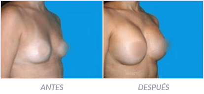 Implantes-de-Senos-02-Cirujano-Plastico-Mexico-DF-Dr-Victor-Pera-Galvez