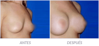 Implantes-de-Senos-07-Cirujano-Plastico-Mexico-DF-Dr-Victor-Pera-Galvez