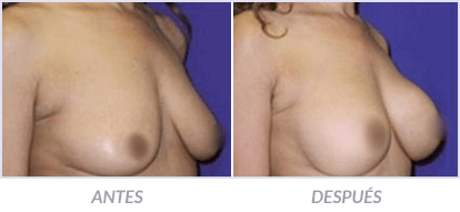 Implantes-de-Senos-09-Cirujano-Plastico-Mexico-DF-Dr-Victor-Pera-Galvez