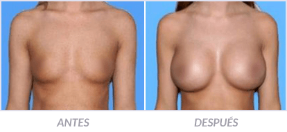 Implantes-de-Senos-10-Cirujano-Plastico-Mexico-DF-Dr-Victor-Pera-Galvez
