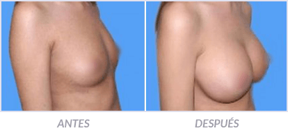 Implantes-de-Senos-11-Cirujano-Plastico-Mexico-DF-Dr-Victor-Pera-Galvez