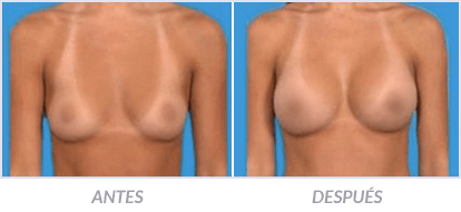 Implantes-de-Senos-12-Cirujano-Plastico-Mexico-DF-Dr-Victor-Pera-Galvez