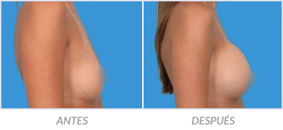 Implantes-de-Senos-13-Cirujano-Plastico-Mexico-DF-Dr-Victor-Pera-Galvez