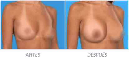 Implantes-de-Senos-14-Cirujano-Plastico-Mexico-DF-Dr-Victor-Pera-Galvez