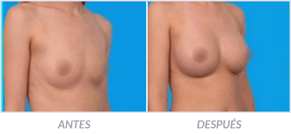 Implantes-de-Senos-15-Cirujano-Plastico-Mexico-DF-Dr-Victor-Pera-Galvez