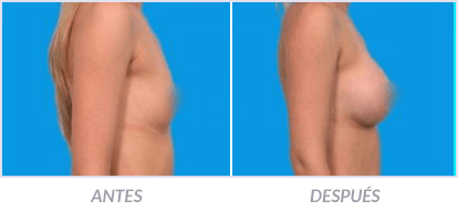 Implantes-de-Senos-16-Cirujano-Plastico-Mexico-DF-Dr-Victor-Pera-Galvez