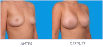 Implantes-de-Senos-17-Cirujano-Plastico-Mexico-DF-Dr-Victor-Pera-Galvez