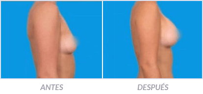 Implantes-de-Senos-18-Cirujano-Plastico-Mexico-DF-Dr-Victor-Pera-Galvez