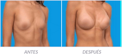 Implantes-de-Senos-19-Cirujano-Plastico-Mexico-DF-Dr-Victor-Pera-Galvez