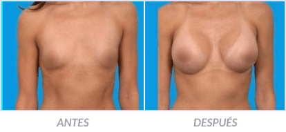 Implantes-de-Senos-20-Cirujano-Plastico-Mexico-DF-Dr-Victor-Pera-Galvez