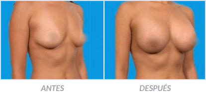 Implantes-de-Senos-21-Cirujano-Plastico-Mexico-DF-Dr-Victor-Pera-Galvez