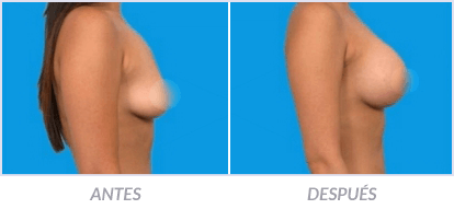 Implantes-de-Senos-22-Cirujano-Plastico-Mexico-DF-Dr-Victor-Pera-Galvez