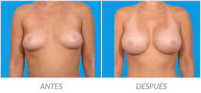 Implantes-de-Senos-23-Cirujano-Plastico-Mexico-DF-Dr-Victor-Pera-Galvez