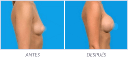 Implantes-de-Senos-24-Cirujano-Plastico-Mexico-DF-Dr-Victor-Pera-Galvez