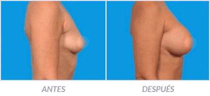 Implantes-de-Senos-25-Cirujano-Plastico-Mexico-DF-Dr-Victor-Pera-Galvez