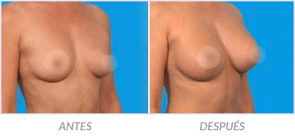 Implantes-de-Senos-26-Cirujano-Plastico-Mexico-DF-Dr-Victor-Pera-Galvez