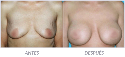 Implantes-de-Senos-27-Cirujano-Plastico-Mexico-DF-Dr-Victor-Pera-Galvez