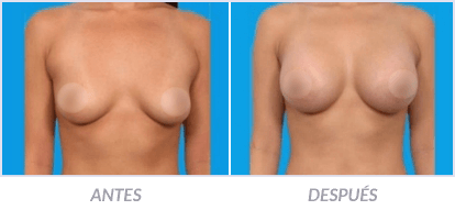 Implantes-de-Senos-28-Cirujano-Plastico-Mexico-DF-Dr-Victor-Pera-Galvez