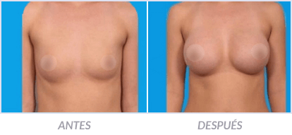 Implantes-de-Senos-29-Cirujano-Plastico-Mexico-DF-Dr-Victor-Pera-Galvez